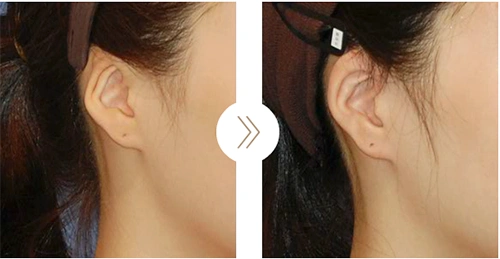 宝宝6种常见畸形耳朵图片照分析各种方案应对不同