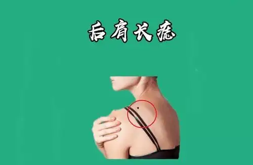肩膀有痣说明什么问题有哪些含义肩膀有痣代表什么