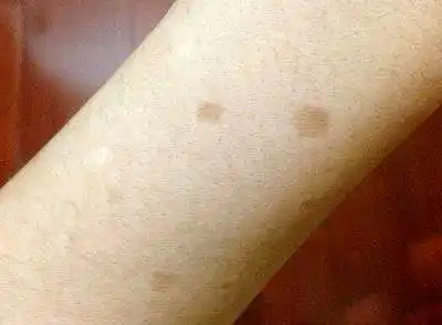 药物,糖基化反应等,也会加速细胞衰老凋亡,色素沉着,诱发或加重老年斑