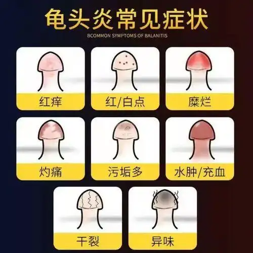 男性包皮垢多应小心包皮龟头炎