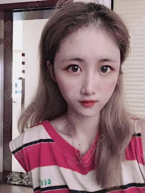 自体脂肪面部填充术后4天_面部填充术后4天_自体脂肪术后4天_春日部