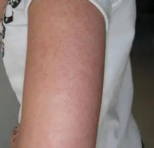 芸蓉集角质舒滑膏关于鸡皮肤的一点想法