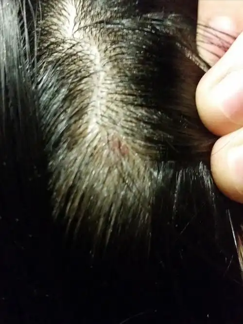 头顶毛茸茸的.  感觉小头皮屑现在有点多,头皮会长小包,头皮痒.