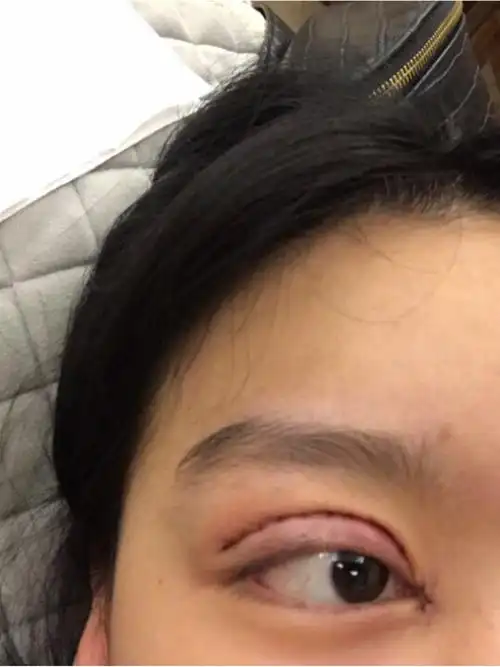 全切双眼皮77开眼角/第11566天/第21566天