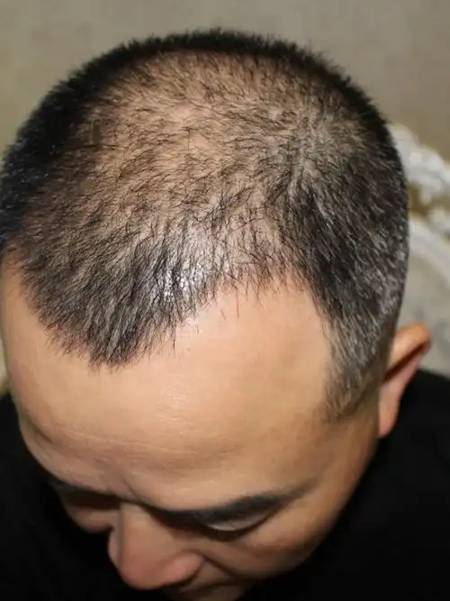 看下图,感觉还是有些稀疏,继续等等种植的头发开始脱_圈子-新氧美容