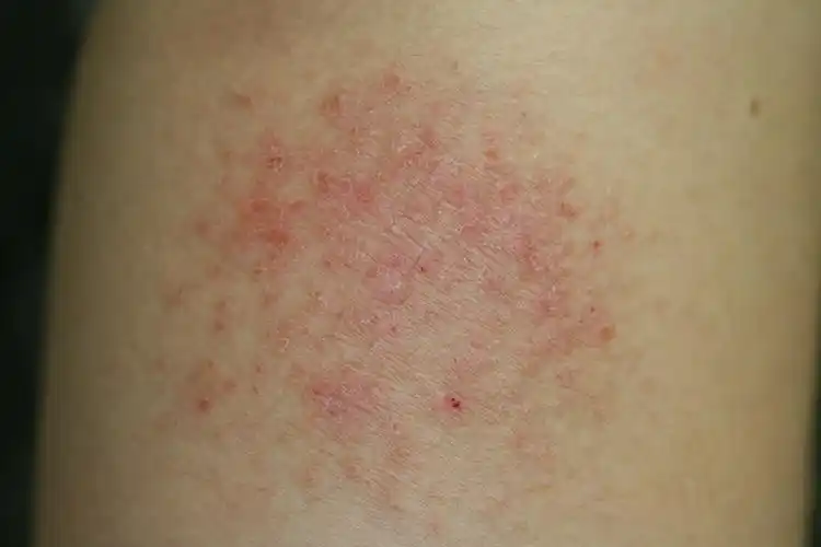 郑州哪家医院治疗湿疹好,郑州肤康医院怎么样