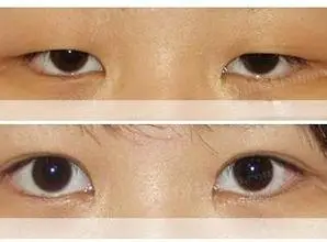 上睑下垂矫正手术价格主要受到以下几方面因素的影响