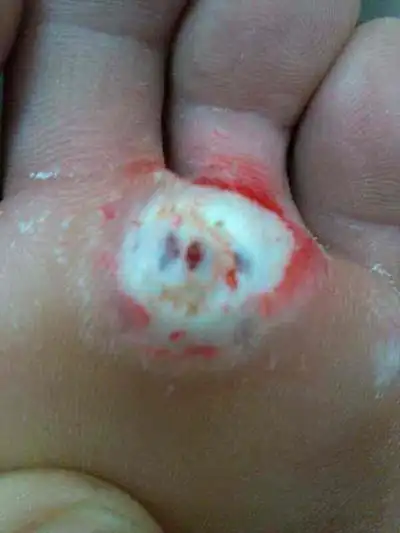 鸡眼根部挖出图片 (9)