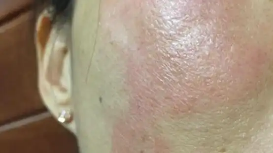 面部皮炎是皮肤科的常见病,多发病.尤其是女性,发病率更高.