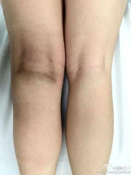 术后常见皮肤反应原创