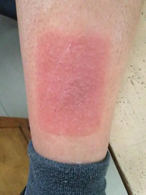 接触性皮炎【膏药过敏】