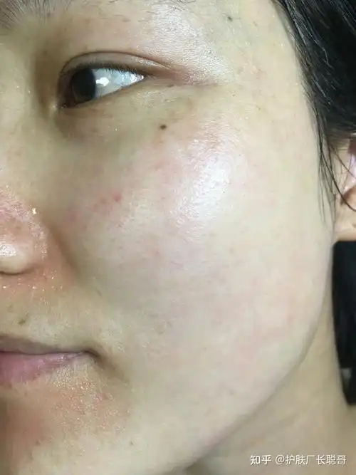 修复油敏肌的护肤要诀,油性敏感皮肤的护理水乳推荐 - 知乎
