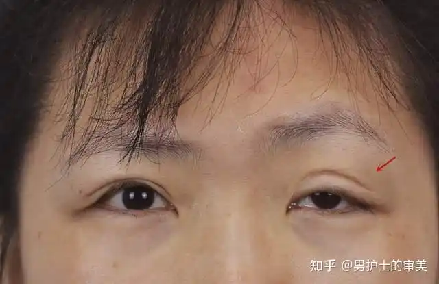 东北姑娘左眼眼睑下垂,做了3次矫正还是不好,来找我们修复. - 知乎