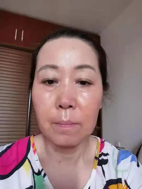 皮肤发红发烫是玫瑰痤疮吗?