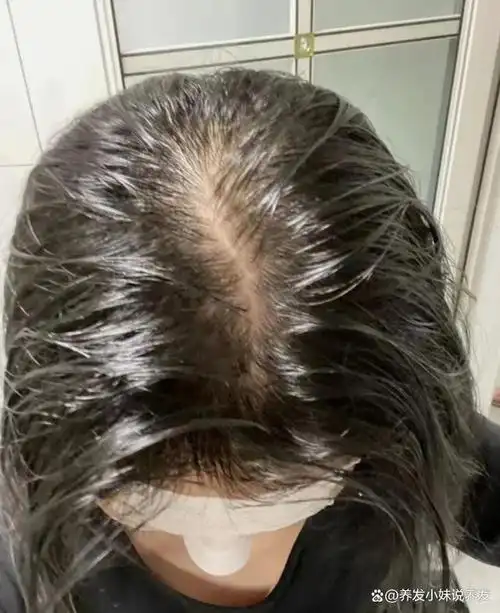 头发细软出油快大量脱发亲测好物推荐低成本恢复健康头皮