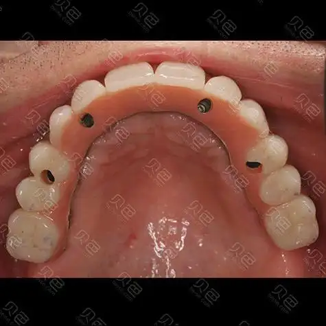 种植到口内效果