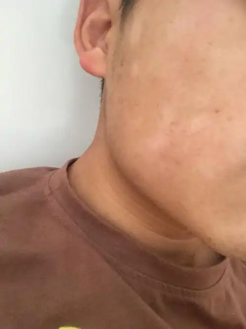 脸颊一块一块白白的斑是什么,只有脸颊上才有,是汗斑吗还是什么,军训