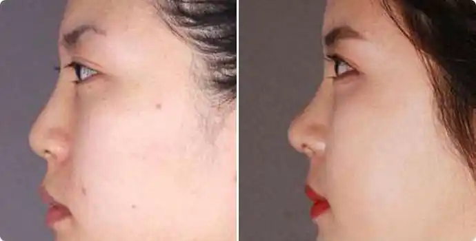 罗旭松玻尿酸丰鼻基底需要多少费用玻尿酸丰鼻基底案例效果对比图上海