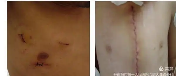 胸腔镜心脏手术和传统心脏开胸手术对比.