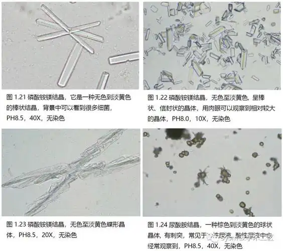 高清图谱尿液结晶形态汇总
