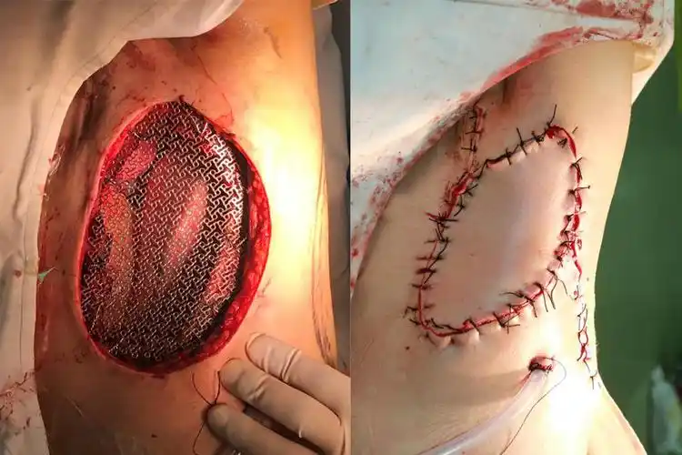 左图为肿瘤切除后安装了金属钛板 右图为胸壁表皮重建后的伤口