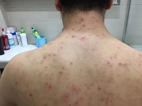 毛囊炎反复难愈求根治本人胸前颈部肩部和背部均长起了脓包