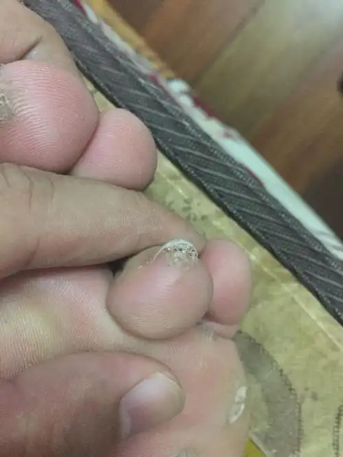 脚上长了这样的肉刺很多.左脚有,右脚没有.这是啥病啊.