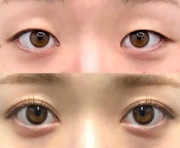 眼窝凹陷做双眼皮,填充脂肪后效果让人惊艳