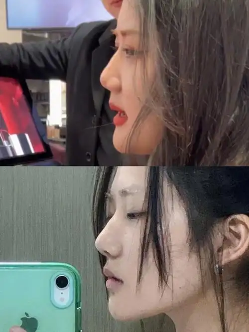 因为小时候摔过一次比较严重 之后就慢慢的比较宽大 因为胖鼻子很肉