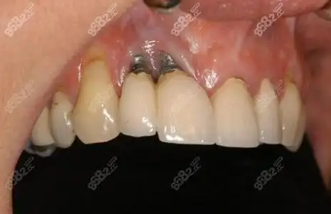 种植牙基台暴露