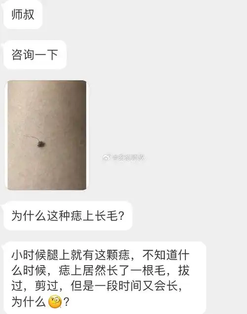 面相学上长毛的痣都是吉痣,也称之为"活痣",百利而无一害