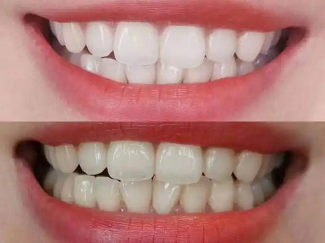 刘涛牙齿磨小后照片演员刘涛为一口烤瓷牙后悔不已