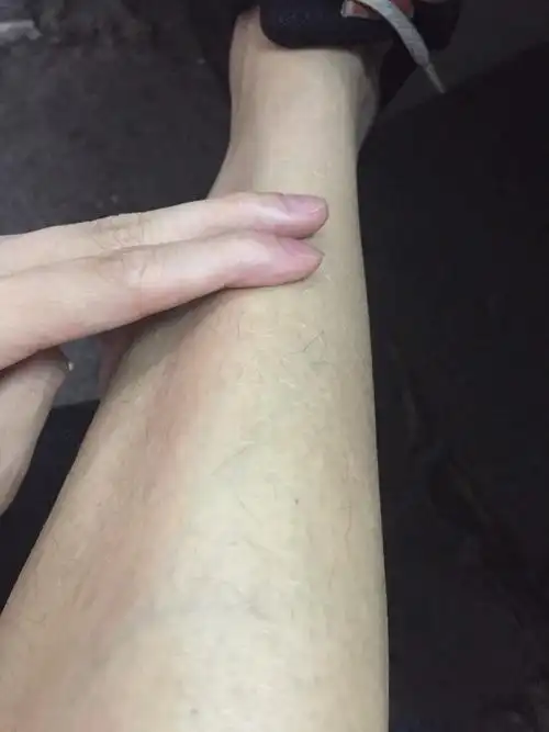 跑步后,小腿前面 按起痛,看图说话