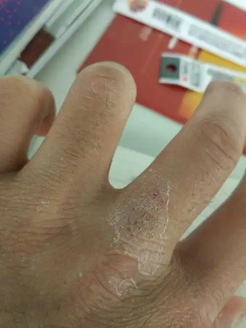 突然发现手指上长这么大一块癣～谁请这是什么癣?该用什么药?