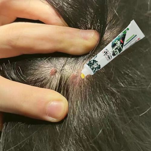 药房同售 毛囊y湿疹头痒头皮屑头部毛囊y头上头皮毛囊y脂溢 云南百草1