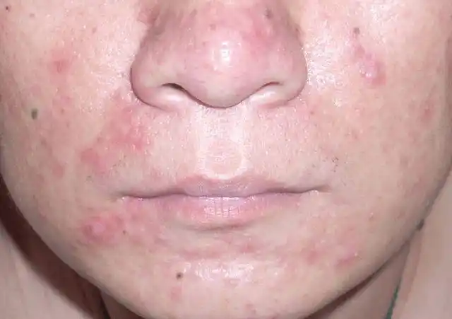 红霉素软膏涂在脸上或有这几个功效多数人还不清楚