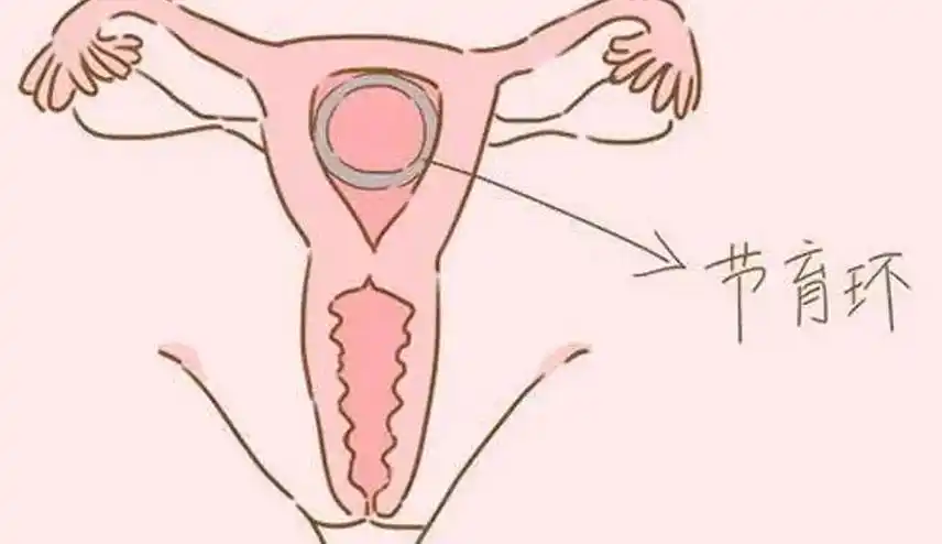 上环对身体的危害有哪些