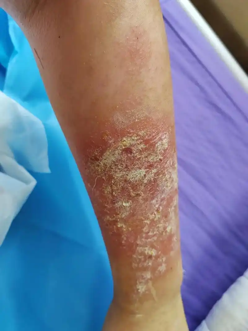 使用康氏药业的新肤得安药物,导致严重的皮肤破损溃烂流水,住院 - 抖