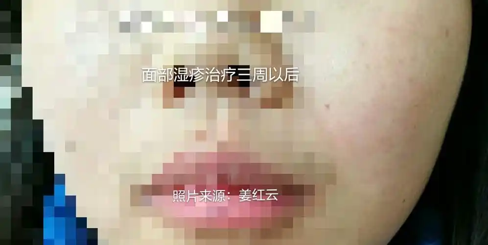 面部湿疹,严重损容! - 好大夫在线