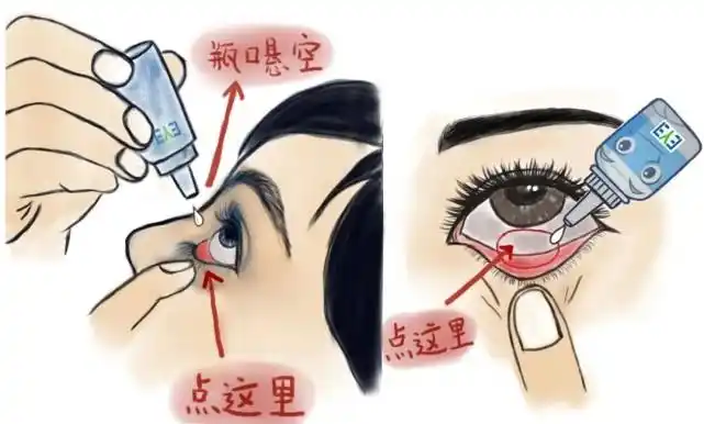 点药时平躺或坐姿头后仰,眼睛往上看,拉开下眼皮,眼药水滴在结膜囊内