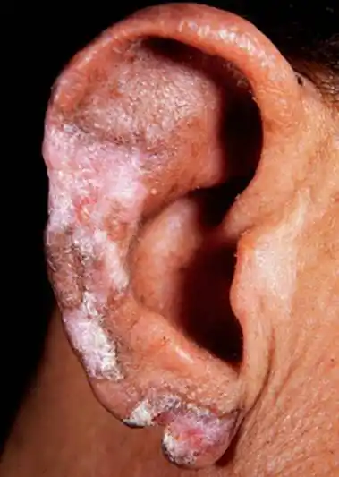 scle)为介于系统性红斑狼疮与盘状红斑狼疮之间的一种特殊的中间类型