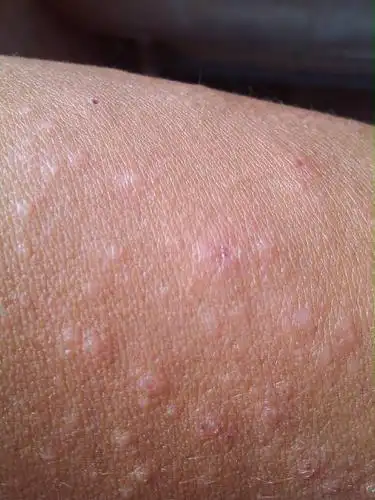 问:我这是日光性皮炎,用炉甘石洗剂后还要擦什么乳膏效果好些?