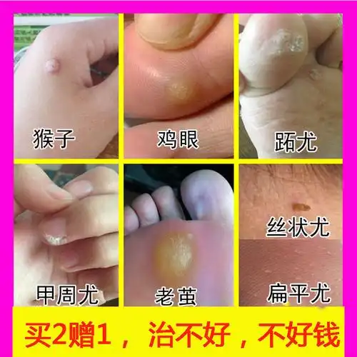去除鸡眼膏贴肉刺特效脚垫老茧猴子刺侯丝状尤病毒尤跖尤跖康膏