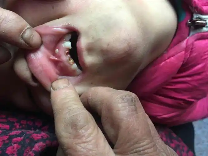 六岁小孩牙龈上长牙齿请问该怎么治疗