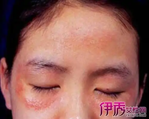 【图】成人面部湿疹图片展现 分析此病的病因及治疗方案