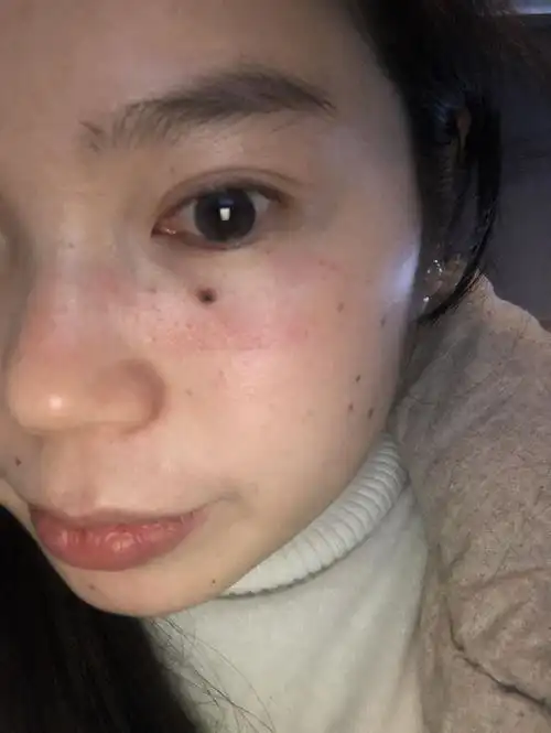网上买的药点了眼睛下面的一颗痣 下面一天之后出了一块红色的 不知道