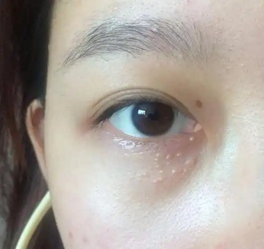 护肤师小凡分享眼睛下面长了脂肪粒怎么办