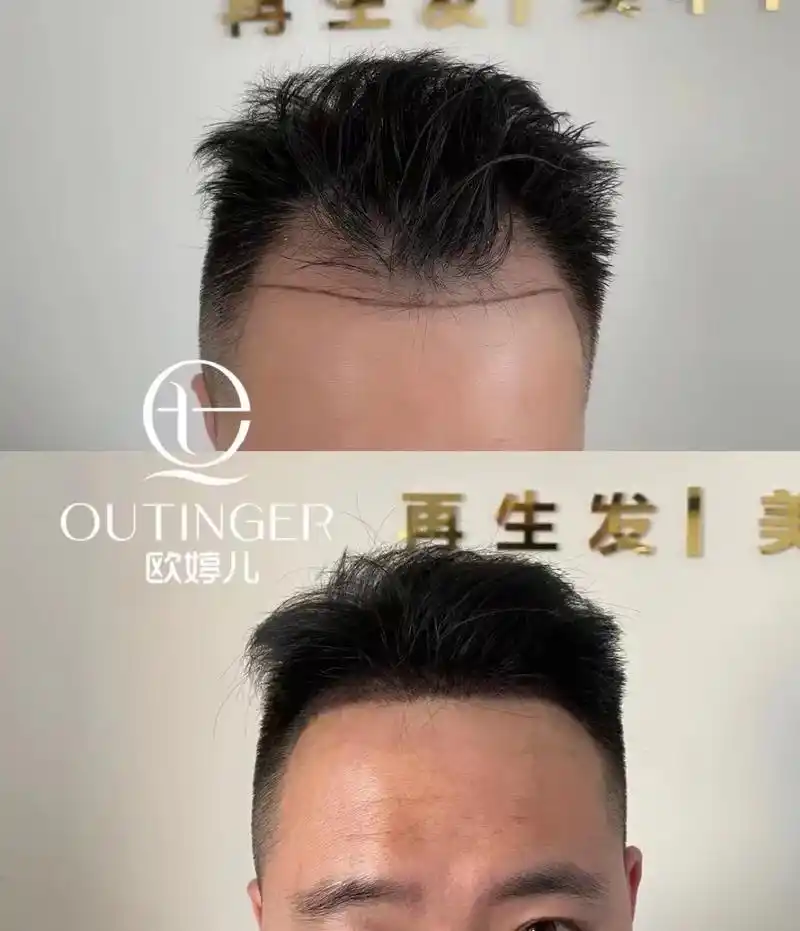 [爱心] 男士发际线操作前后对比 m型脱发是男士脱发最常见的 - 抖音