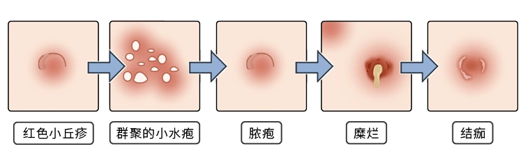 为什么男人会选择嫖娼?_症状_外阴_严重