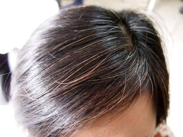 女子白头发日渐增多,不要以为自己老了,可能是缺乏这4种营养